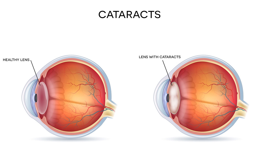 Cataracts2_web